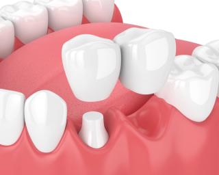 3D render of jaw with dental cantilever bridge.