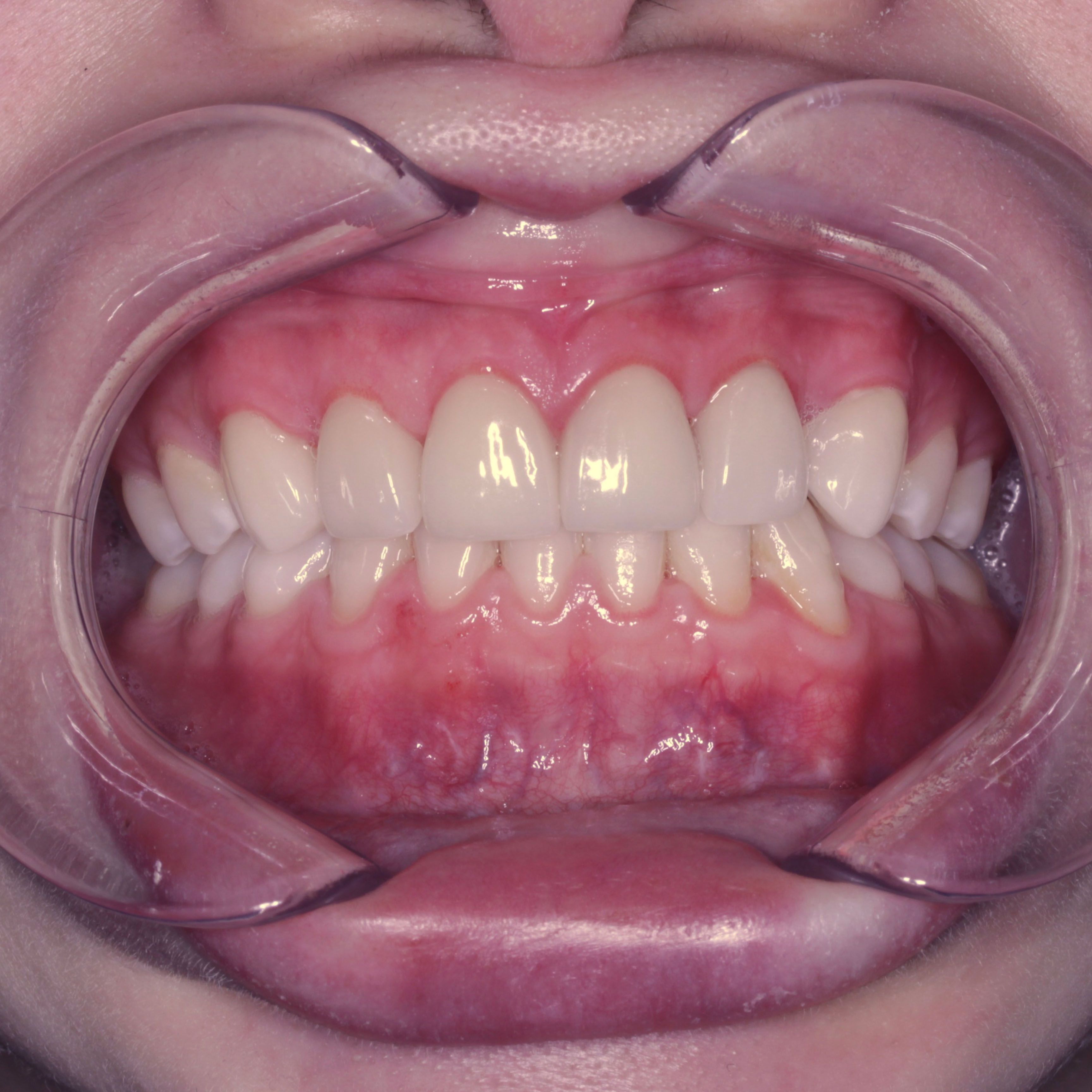 Porcelain Veneers After