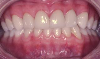 Porcelain Veneers After