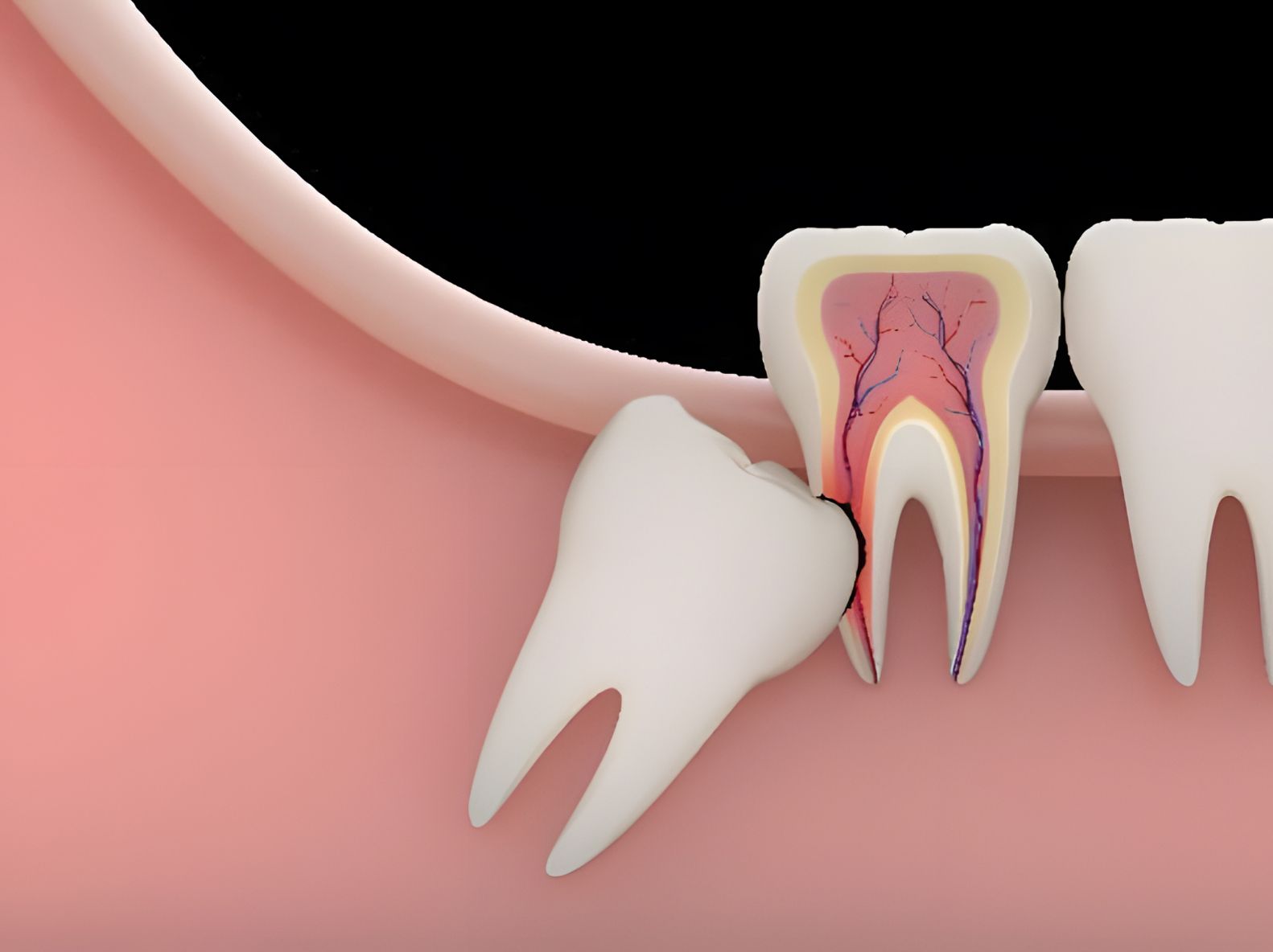 Wisdom Teeth Extractions