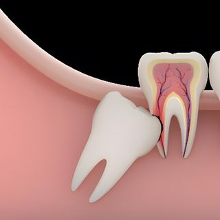 Wisdom Teeth Extractions
