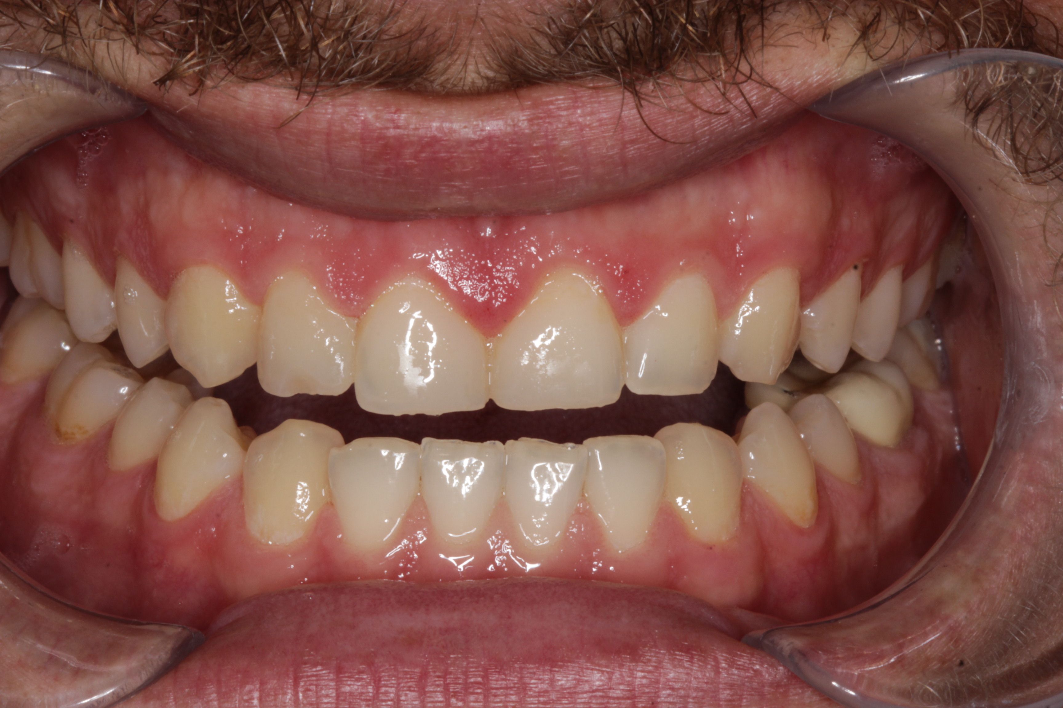Crown Lengthening Surgery and Veneers