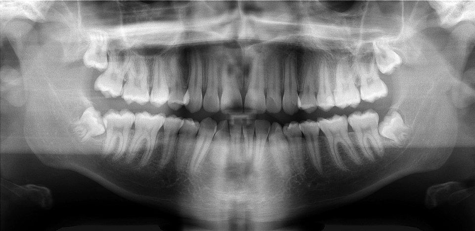 opg xray
