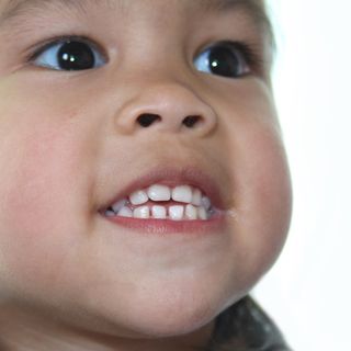 Image of a child with an open bite.