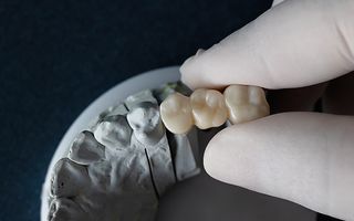 What is a dental bridge?