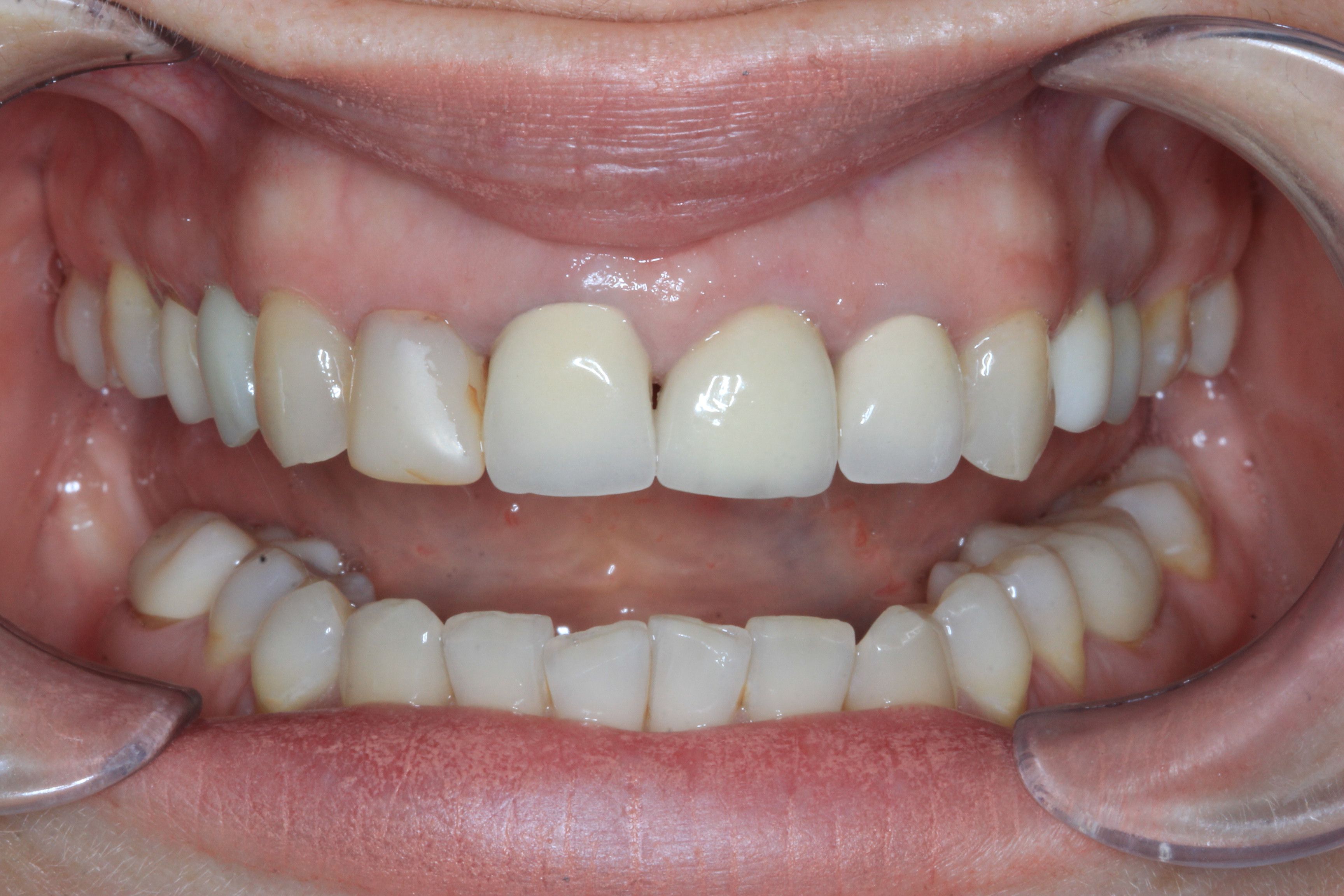 Dental Bridge before