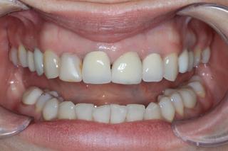 Dental Bridge before