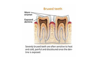 Diagram of bruxed teeth (grinded teeth)