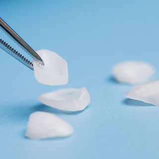 Indirect veneers: Porcelain veneers