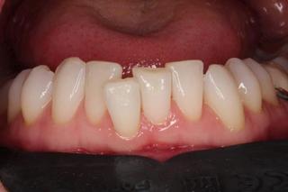 Clear Aligners 2 - Before