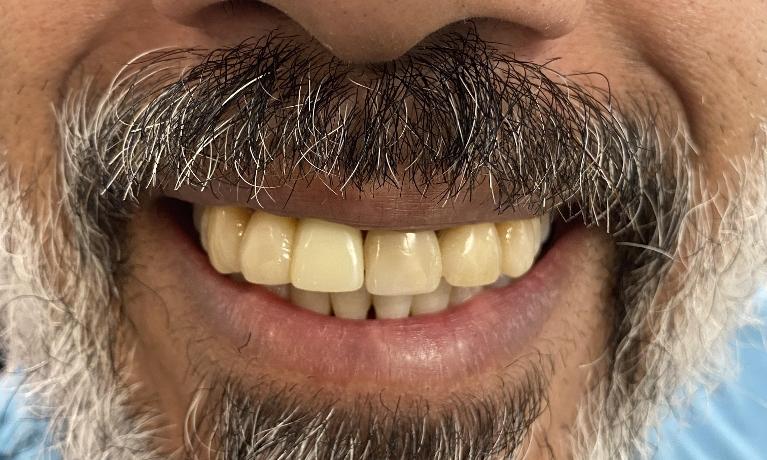 Cosmetic Dentistry - Before