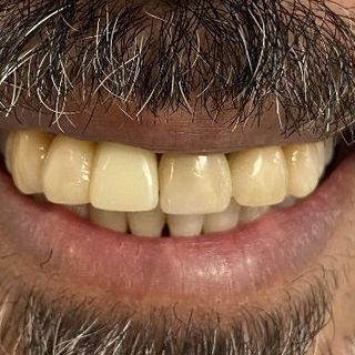 Cosmetic Dentistry - Before