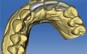 CEREC is used to ‘virtually reconstruct’ the missing teeth. These teeth are then merged with the 3D xray so that when implant positioning is determined it is done with not only anatomy in mind but also final teeth positions…