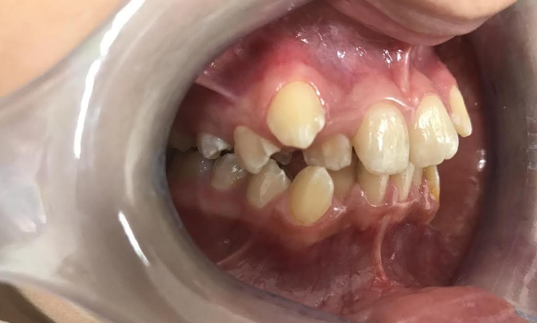 Braces and Invisalign - Before - Left Side