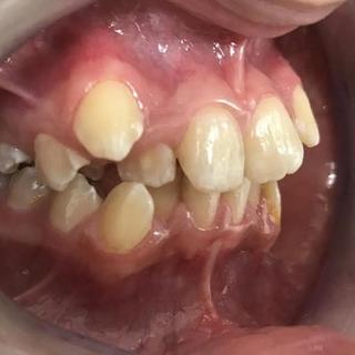 Braces and Invisalign - Before - Left Side