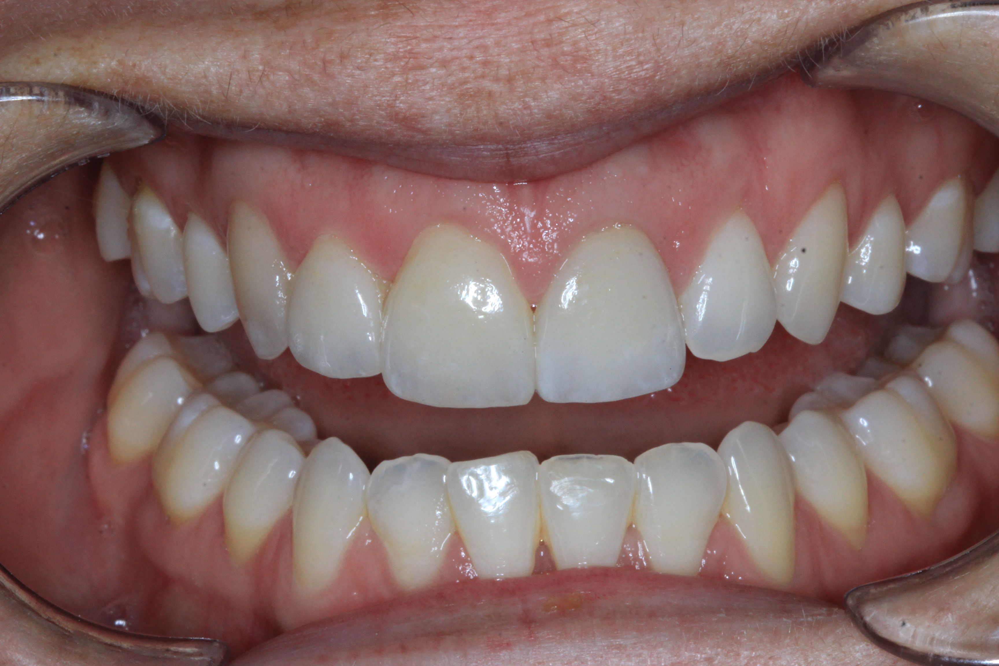 Crown and veneers to fix discoloured and uneven teeth before