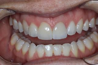 Crown and veneers to fix discoloured and uneven teeth before