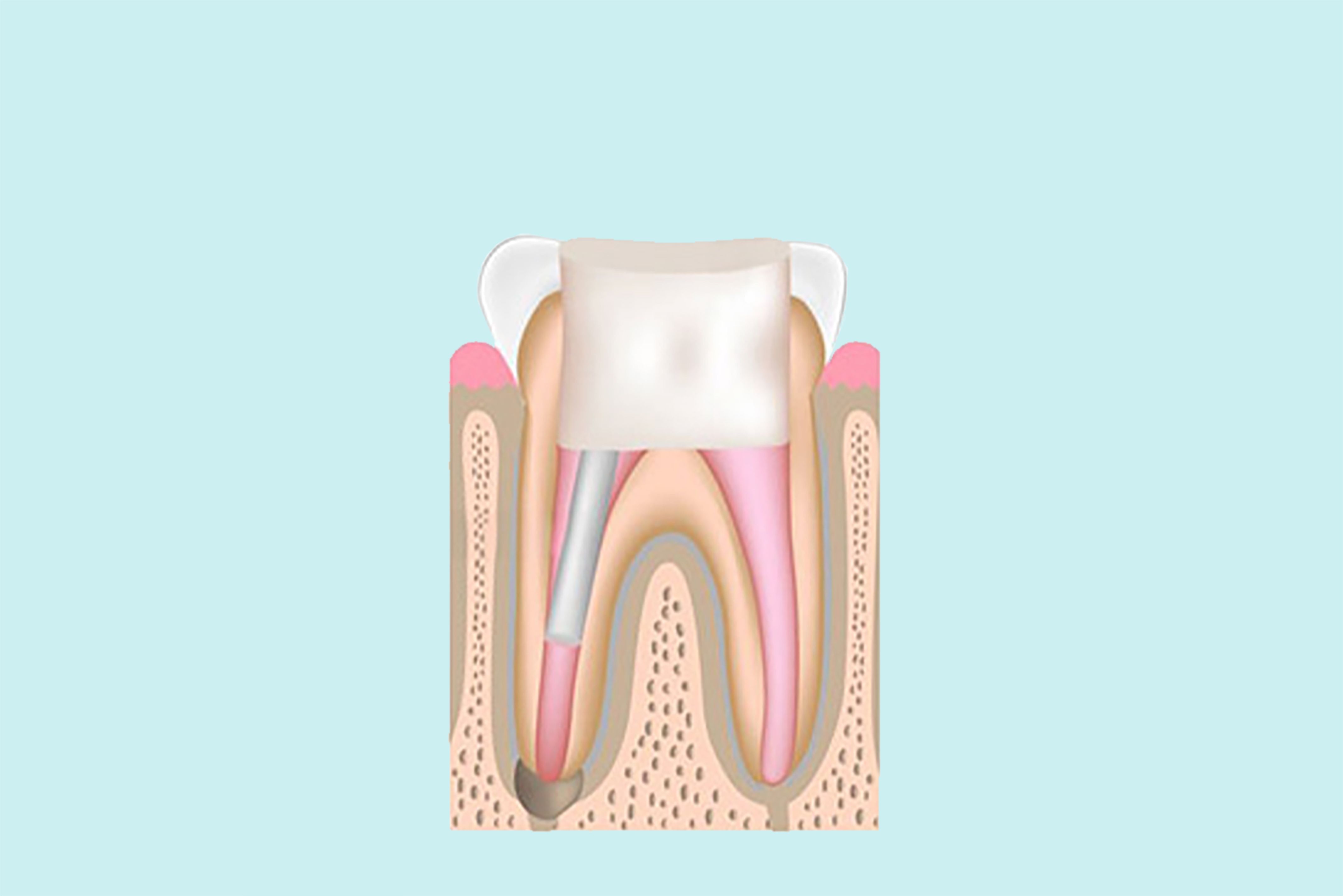 Step 3 — Restoring the tooth