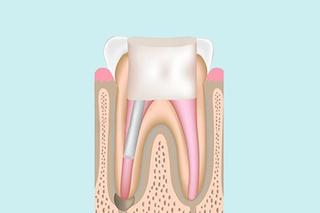 Step 3 — Restoring the tooth