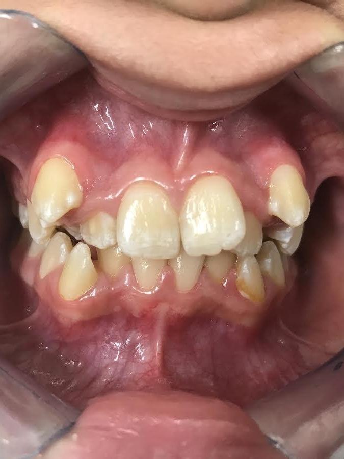Braces and Invisalign - Before