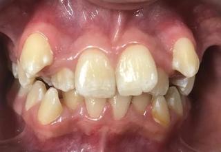 Braces and Invisalign - Before