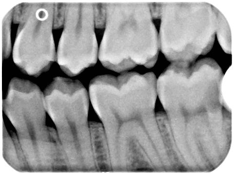 bitewing xray