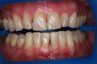 Teeth Whitening 1 - Before