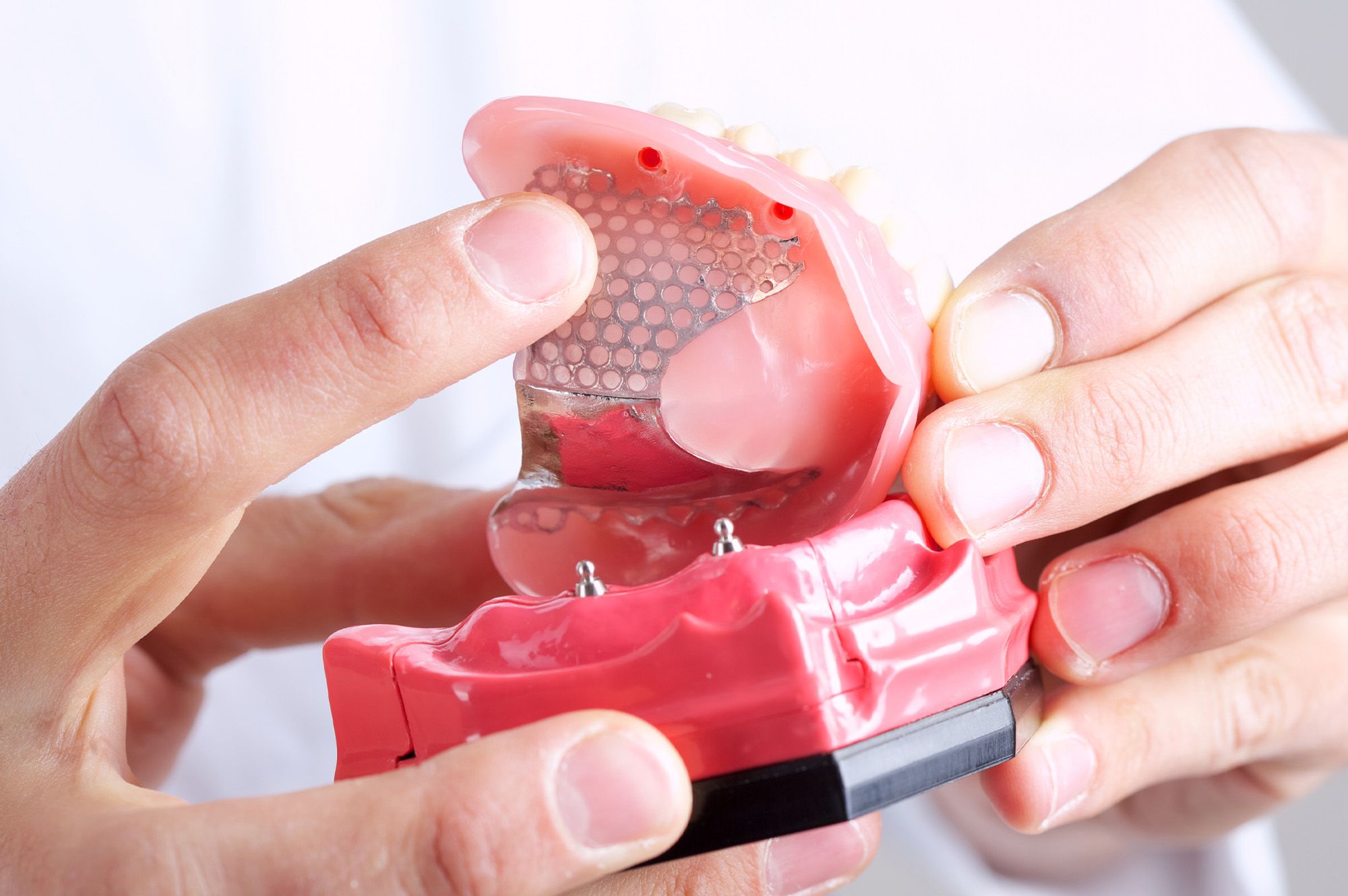 Implant-retained dentures