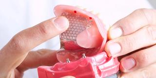 Implant-Retained Dentures