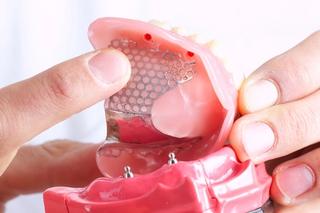 Implant-retained dentures