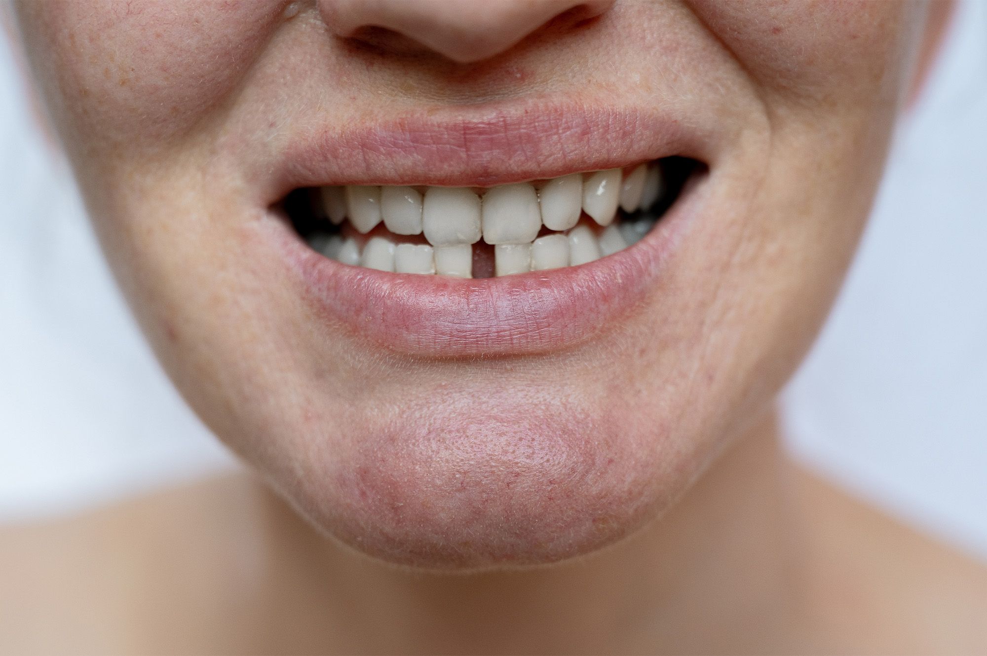 Other reasons to get veneers include
