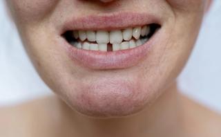 Other reasons to get veneers include