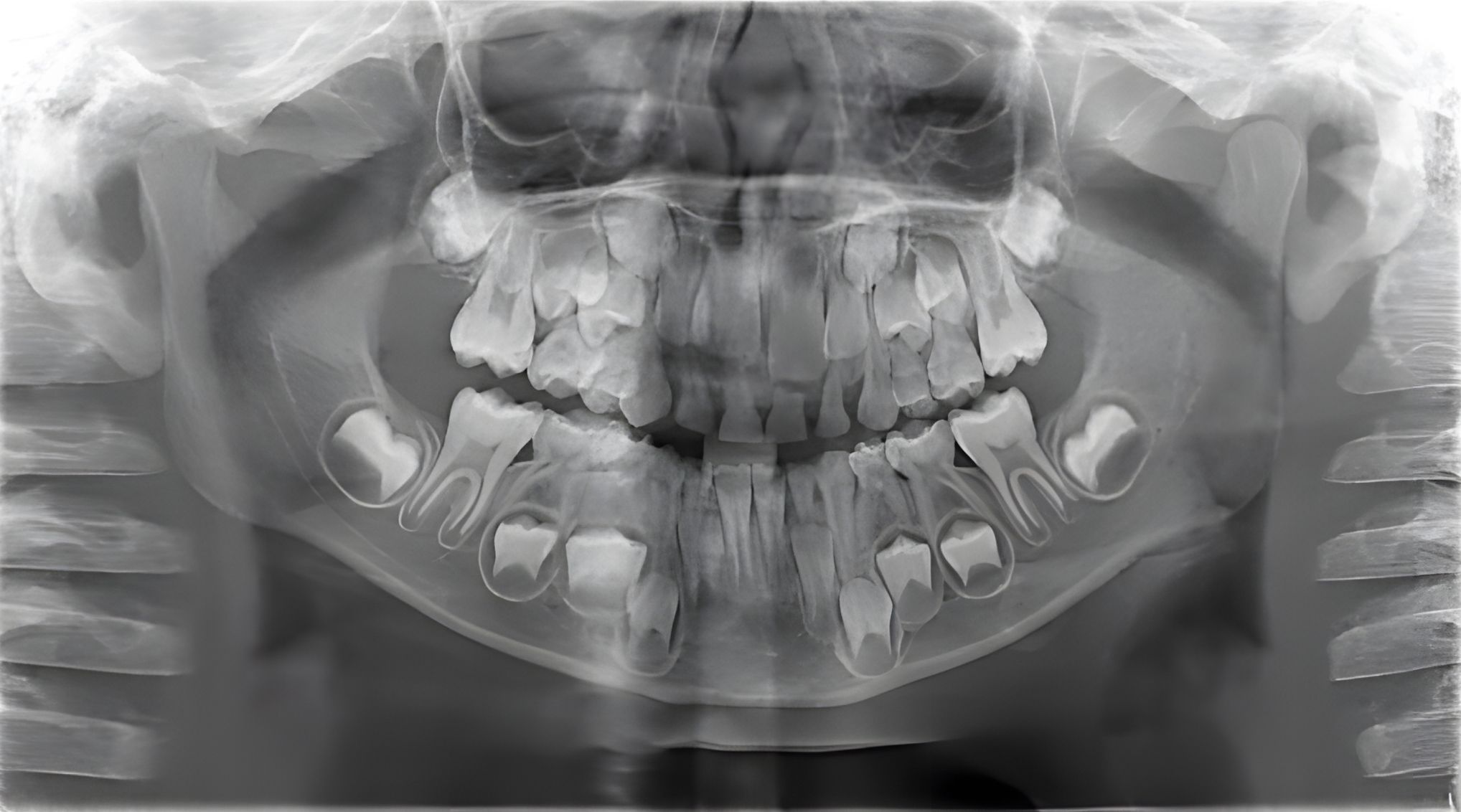 Baby (Primary) Teeth