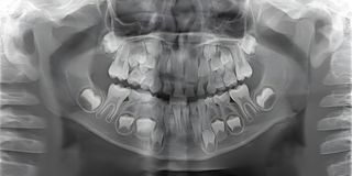 Baby (Primary) Teeth