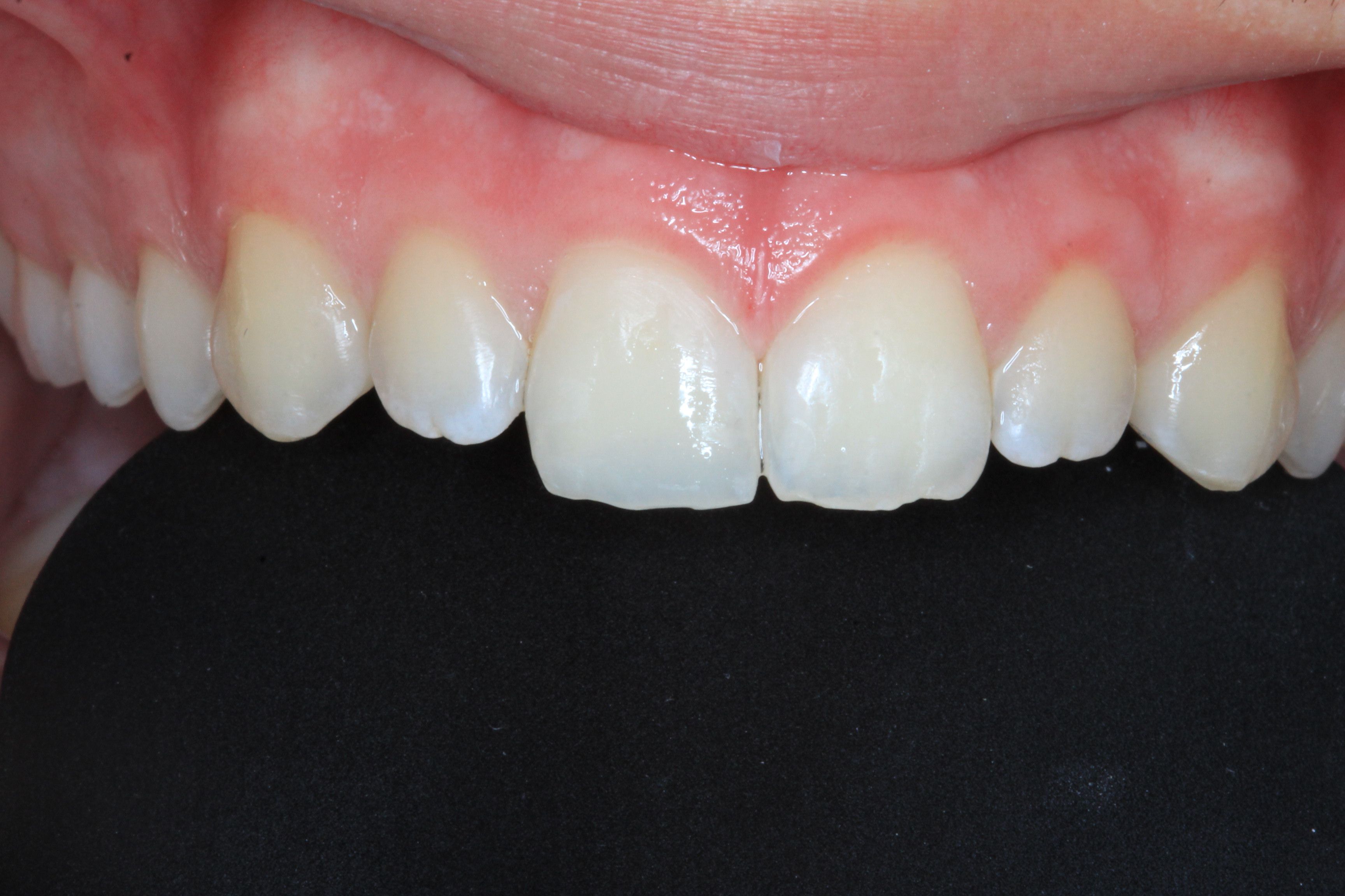 Front Tooth Filling
