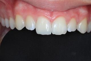 Front Tooth Filling