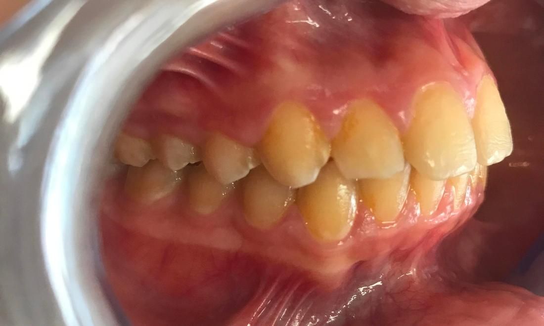 Braces and Invisalign - After - Left Side