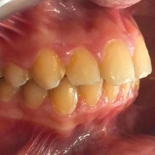 Braces and Invisalign - After - Left Side