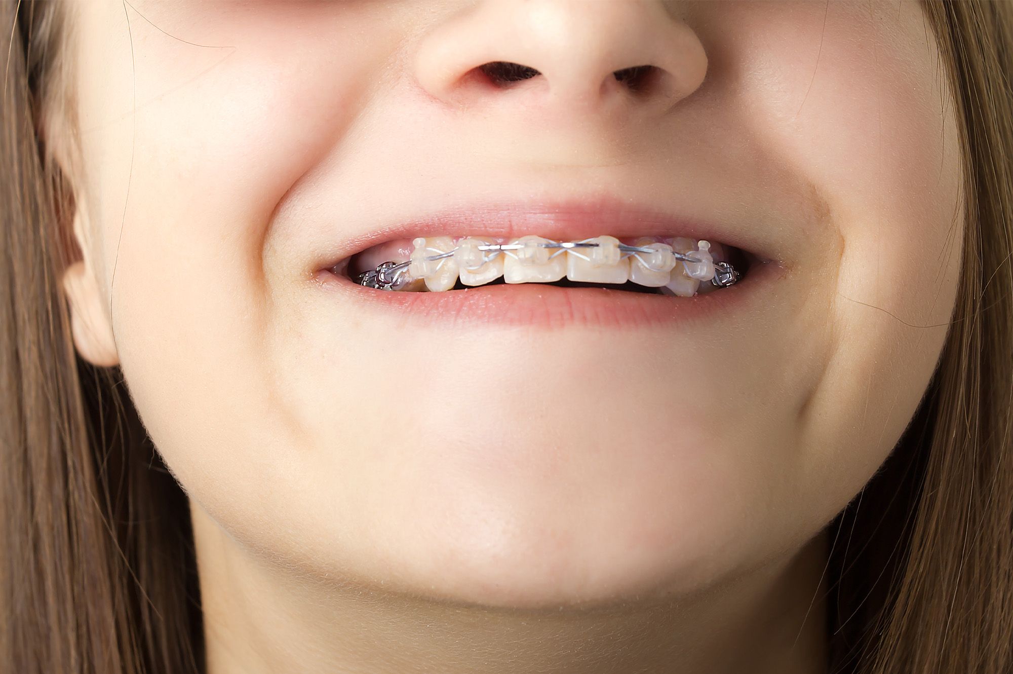 Ceramic Braces