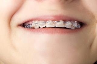 Ceramic Braces