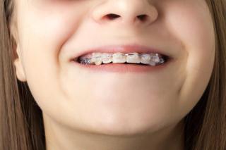 Orthodontics for Young Children