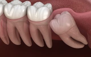 3D render of an impacted wisdom tooth