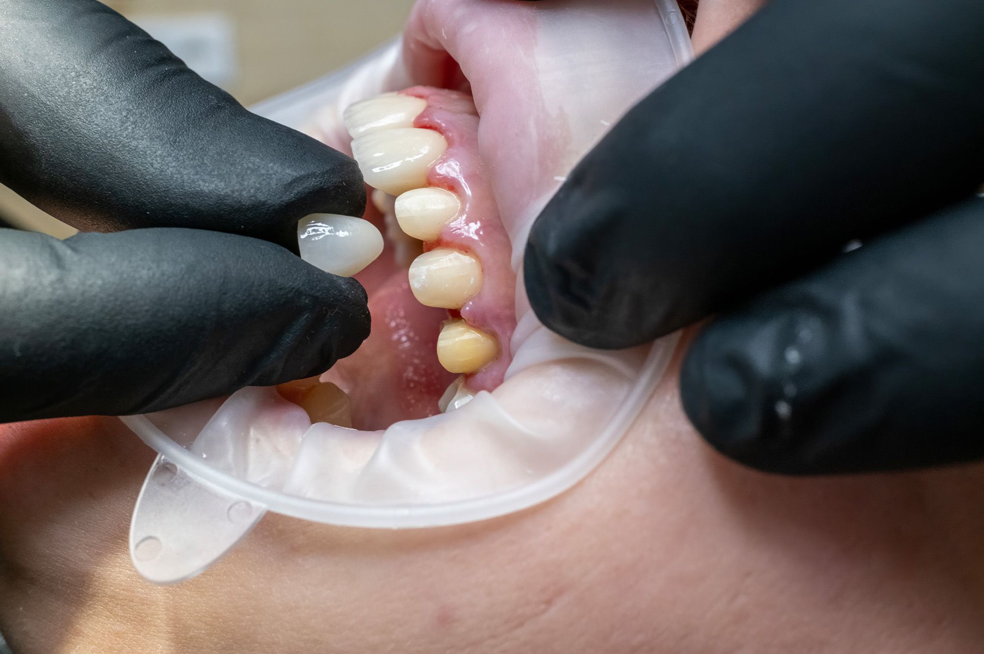 2. Tooth Preparation