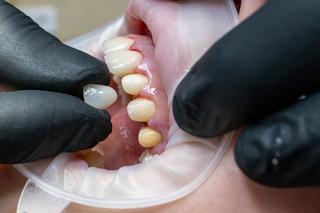 2. Tooth Preparation