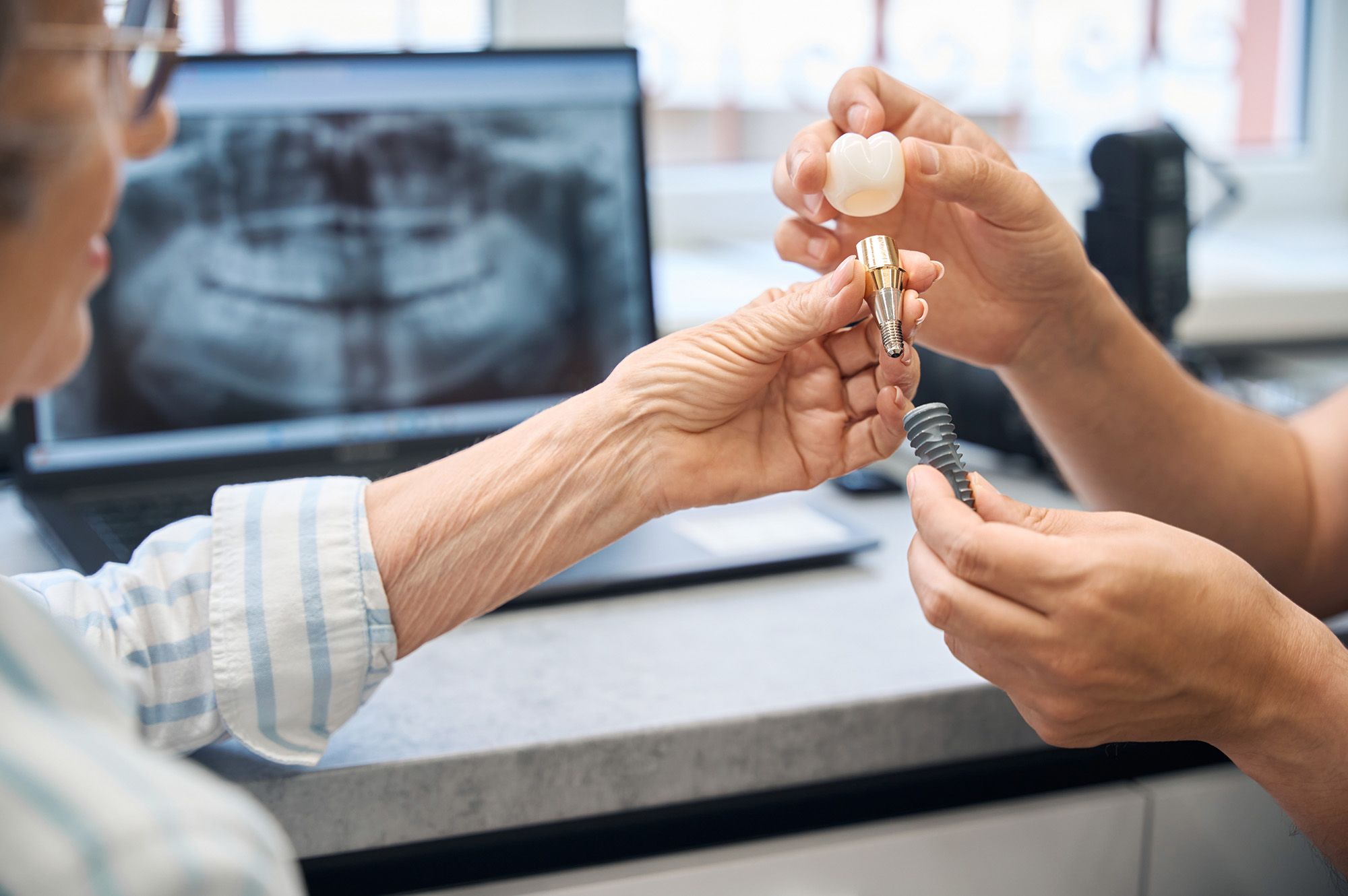 Dental Implants Moonee Ponds Dental Group