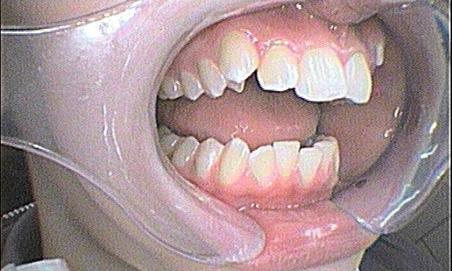 Braces and Invisalign - Before - Left Side