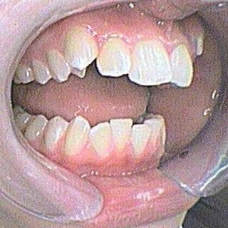 Braces and Invisalign - Before - Left Side