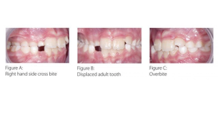 Myobrace before treatment on a child