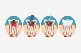 What is a Root Canal Treatment?
