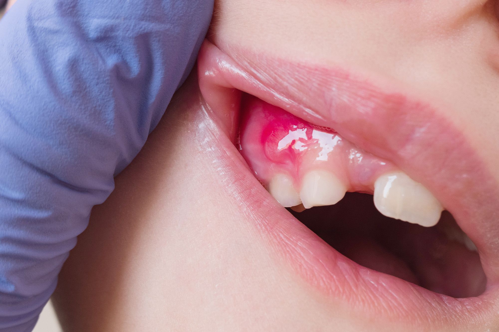 Dental Abscess